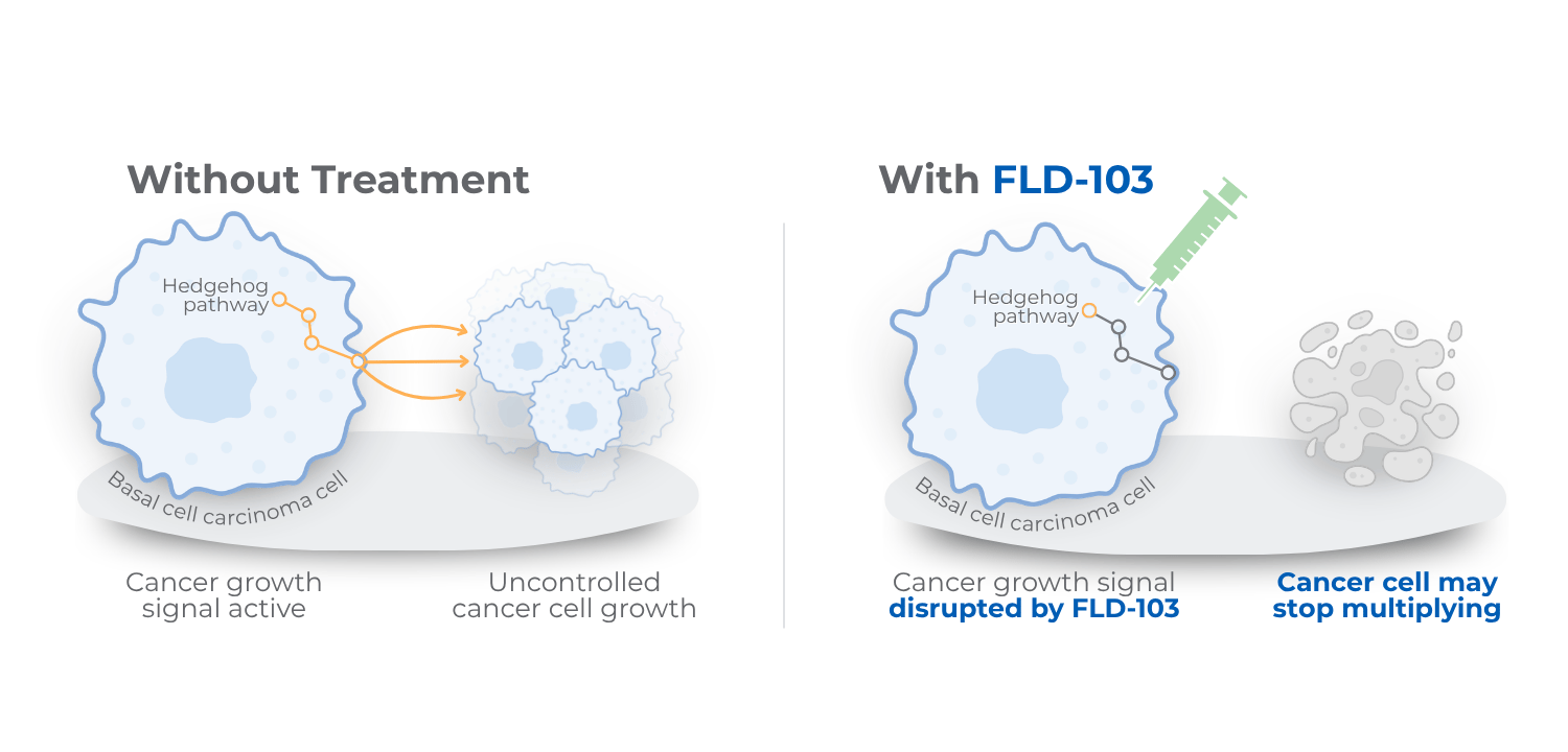 FLD-103 MoA Simplified (Patients)